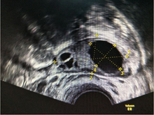 Load image into Gallery viewer, Wireless Ultrasound scanner transvaginal 6.5 MHZ TRANSCARE-SCAN-5.2
